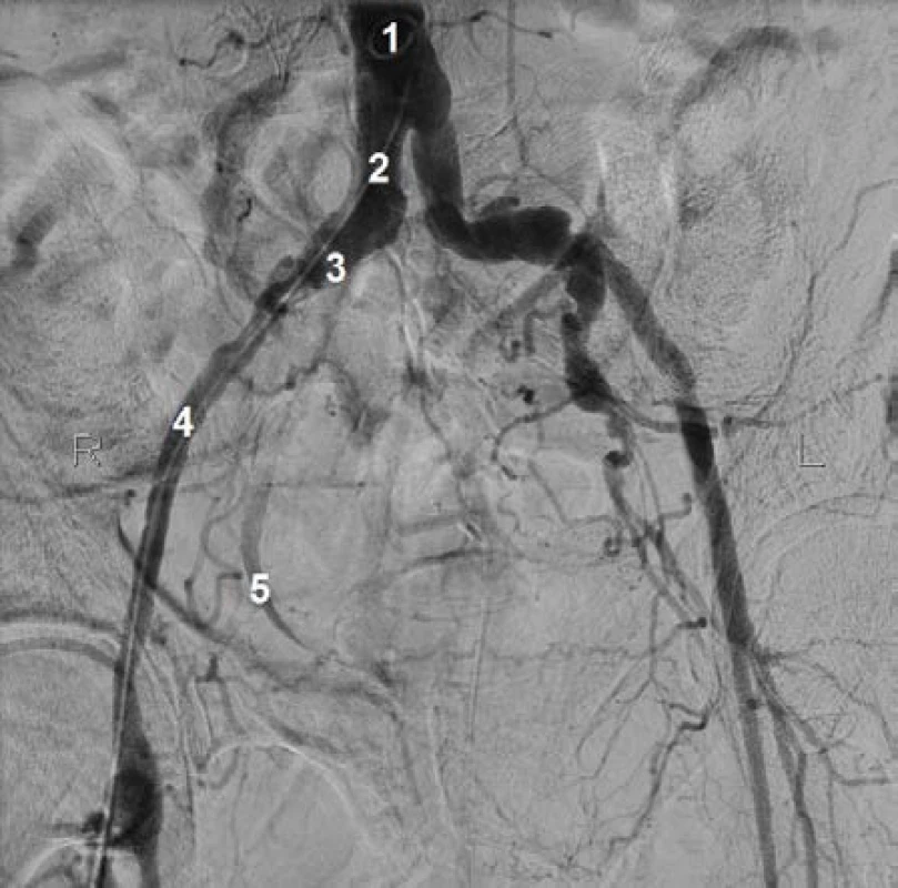 Angiografie břišní aorty a pánevních tepen. 1) Břišní aorta, 2) společná ilická tepna vpravo, 3) odstup vnitřní ilické tepny (vpravo), 4) zevní ilická tepna vpravo, 5) pravý močovod (s kontrastní látkou)
Fig. 2 Angiography of the abdominal aorta and pelvic arteries. 1) Abdominal aorta, 2) right common iliac artery, 3) distance of internal iliac artery (right), 4) external iliac artery, 5) right ureter (with contrast agent)