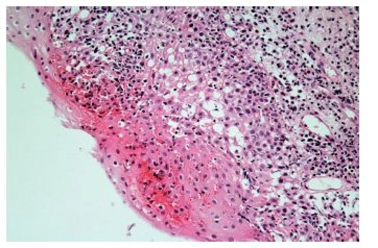 Herpetická ezofagitida. V některých případech HSV ezofagitidy nemusí být charakteristické inkluze zastiženy a onemocnění se prezentuje pouze balónovitou degenerací epitelií a zánětlivým infiltrátem s různým poměrem lymfocytů a eutrofilů (HE, 400x).