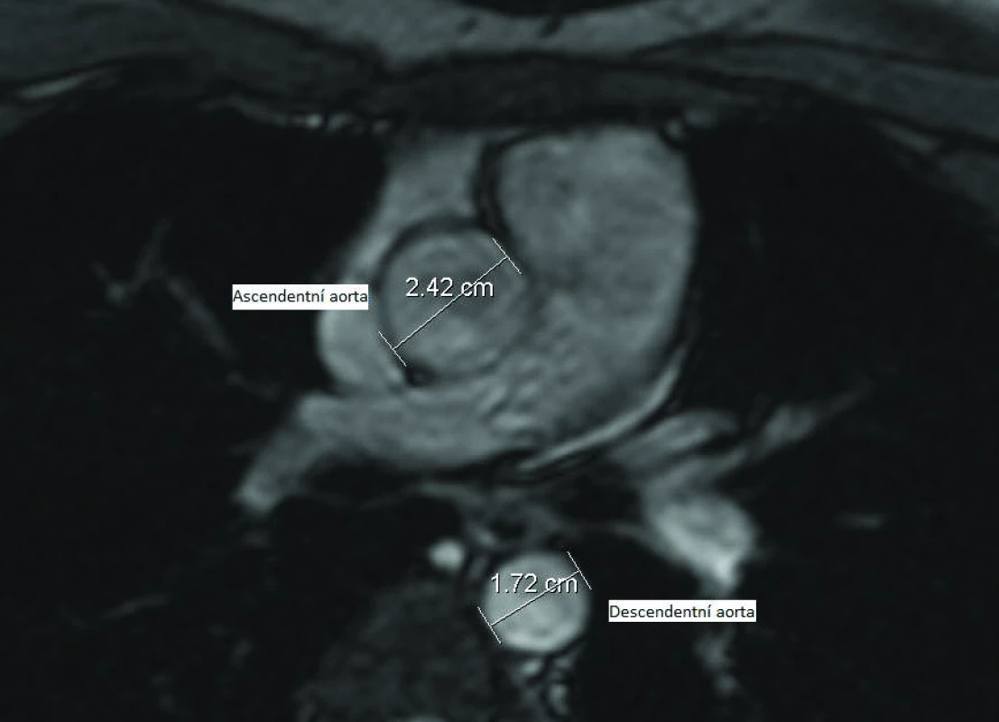 MRI hrudní aorty – stanovení průměrů ascendentní a descendentní aorty na úrovni pravé větve plicnice.