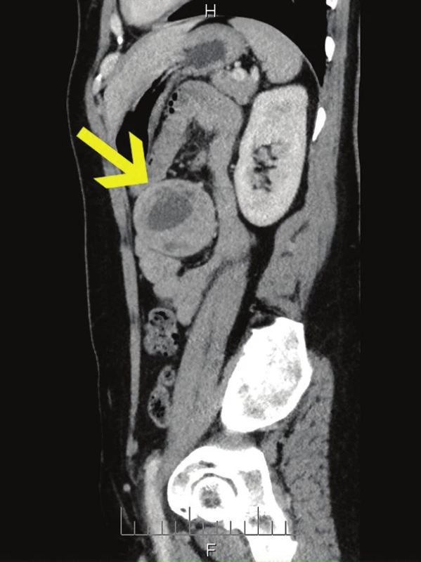 CT s tumorem v levém mezogastriu, sagitální řez
Fig. 2: CT scan with tumour in the left mesogastrium, sagittal section