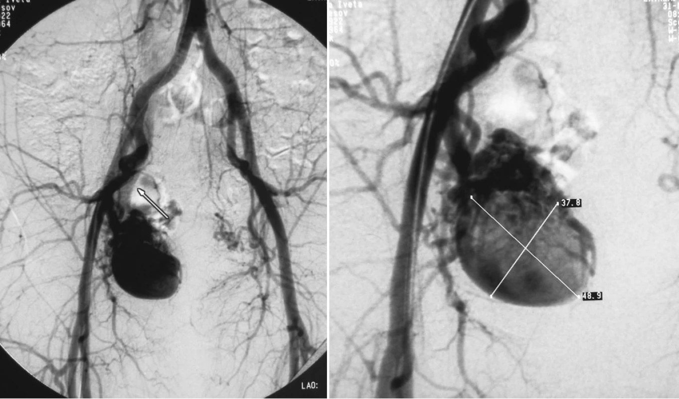 a, b. Pacient č. 2. DSA vyšetrením zobrazená aneuryzma arteria ilaca interna vpravo veľkosti 49x38mm
Pic. 4a, b. Patient Nr. 2: DSA examination revealing the internal iliac artery aneurysm on the right, measuring 49x38mm