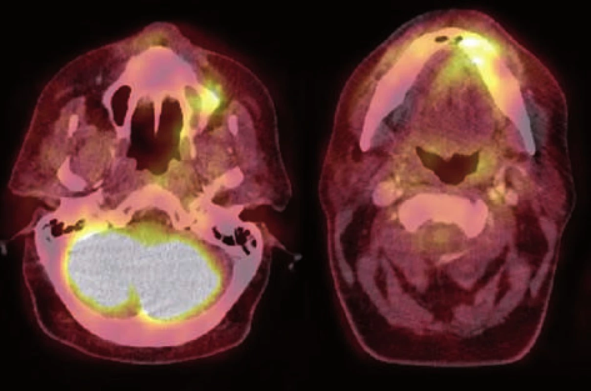 18F-FDG – PET/CT pacienta z obr. 2, 3, axiální řezy – zvýšená akumulace radiofarmaka v oblastech osteonekróz v maxile a v mandibule. (Zdroj obr.: Klinika zobrazovacích metod LF UK a FN Plzeň)