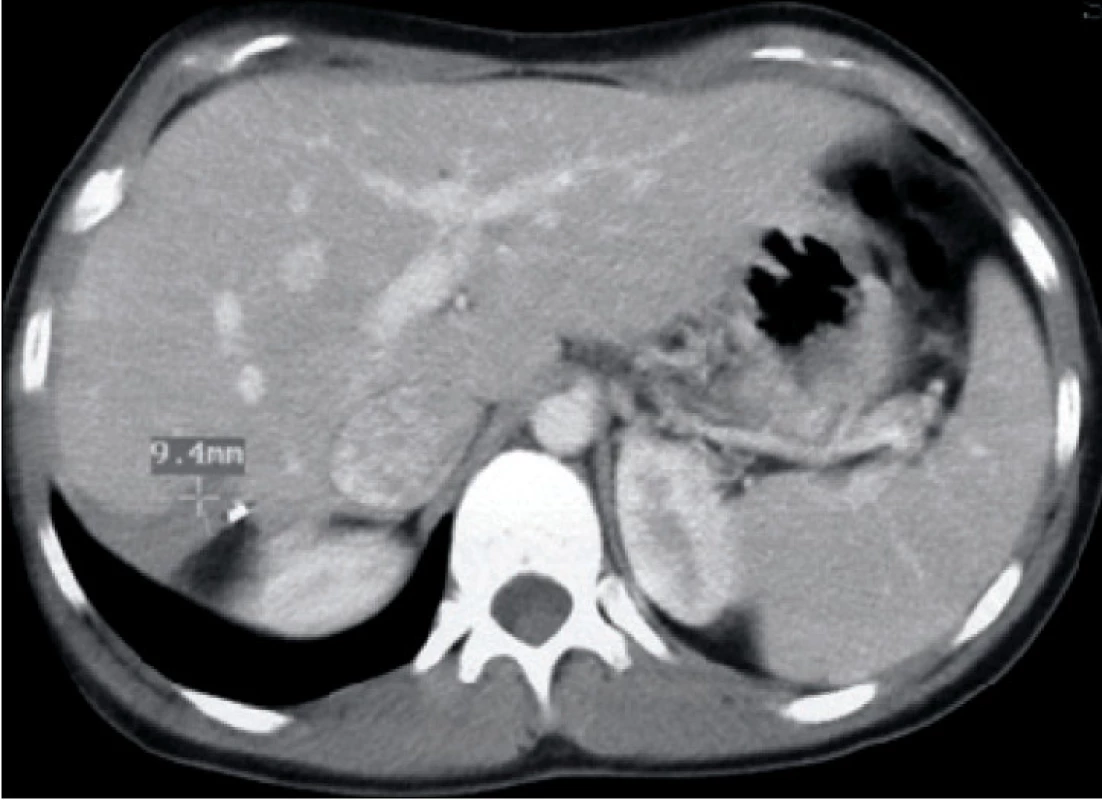 Kontrolní CT snímek břicha u operovaného pacienta s poraněním jater IV. stupně jeden rok po operaci