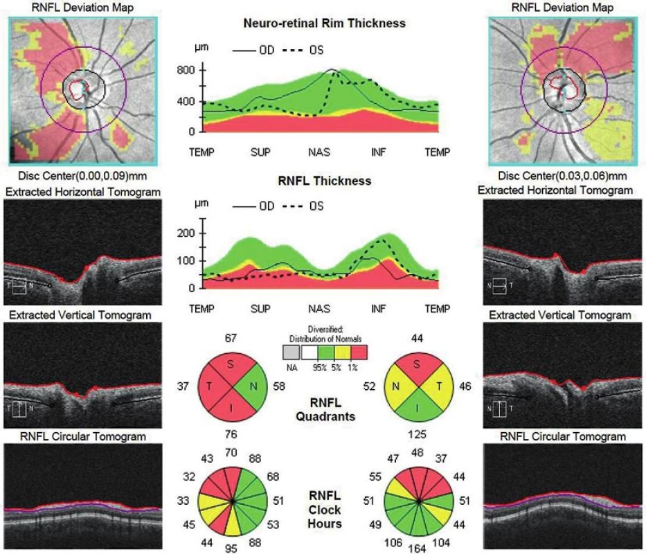 OCT papíl zrakových nervov oboch očí s jasným poklesom hrúbky RNFL.