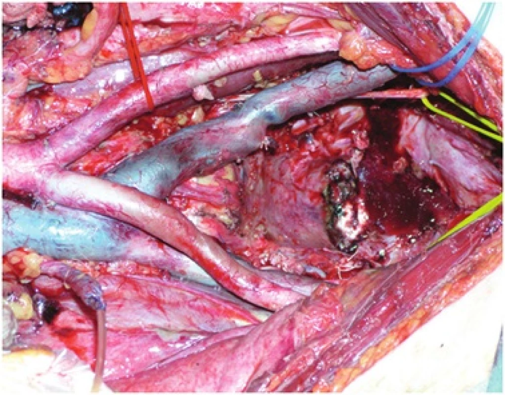 Stav po totální pelvické exenteraci
Fig. 1: Small pelvis after total pelvic exenteration