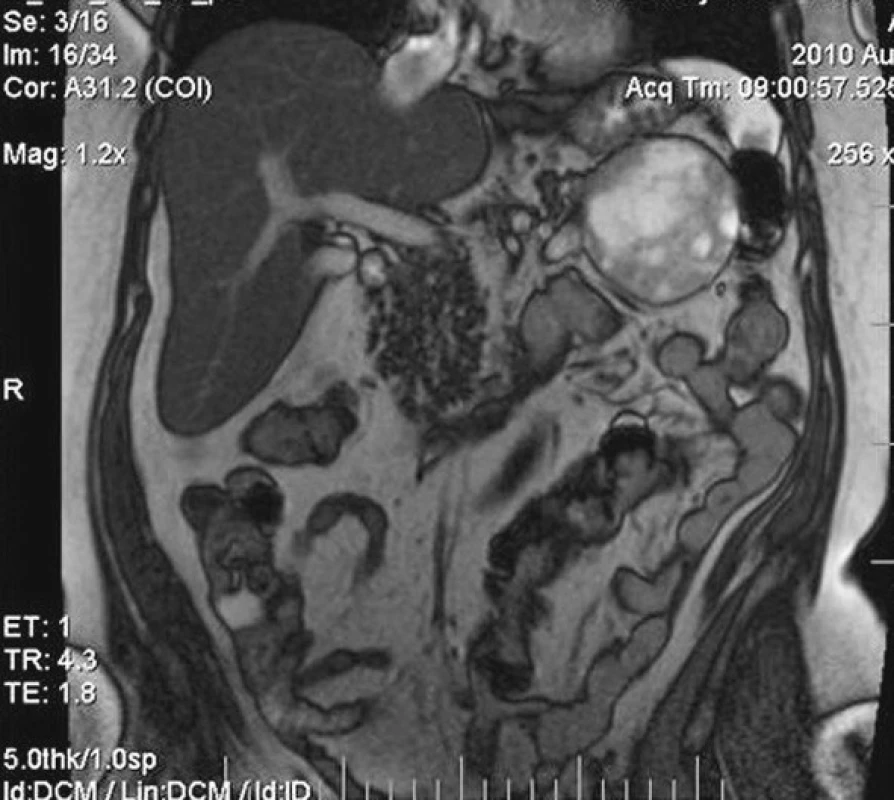 MRI vyšetrenie so zobrazeným tumorom vo frontálnej rovine
Fig. 6. MRI examination depicting the tumor, frontal view