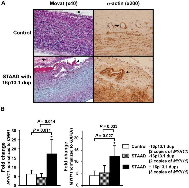 Pathological abnormalities and <i>MYH11</i> expression levels in aortic tissue associated with 16p13.1 duplication in patients with staad.