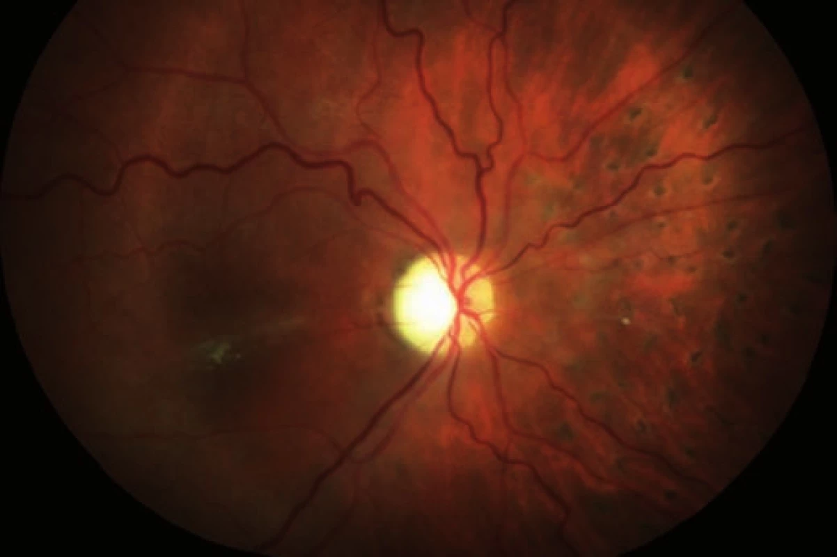 Sumovaný snímek dvou barevných fotografií očního pozadí 2 měsíce po operaci: retinální řečiště je průchodné, ale nepravidelně ztenčené a omezeně plněné (zejména nazální kvadrant). Papila je bledá – počíná atrofie, v nazálním kvadrantu přetrvává žlutý embolus v arteriálním řečišti