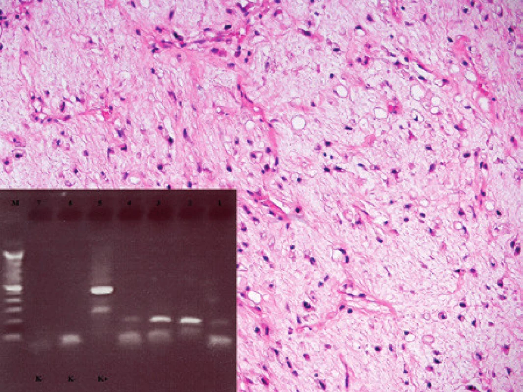 Kazuistika 4. Myxoidní liposarkom. Patrná je hojná kapilarizace, myxoidní stroma a roztroušené nádorové buňky, z nichž některé se diferencují v lipoblasty. Barveno hematoxylinem a eozinem (původní zvětšení 100x). Vložený obrázek: Agarózový gel s detekcí fúzního genu FUS/DDIT3, který je produktem translokace t(12;16). Zprava: 1. Slabá amplifikace fúzního genu FUS/DDIT3 ve vzorku z primárního nádoru (RNA izolovaná z parafínového bloku z roku 2007), 2. vzorek z pravé axily – rok 2009, 3. vzorek recidivy v pravé axile – rok 2011, 4. vzorek z myokardu (RNA izolovaná z parafínového bloku), 5. pozitivní kontrola RT-PCR, 6. negativní kontrola RT, 7. negativní kontrola PCR, M - 100 bp velikostní marker.