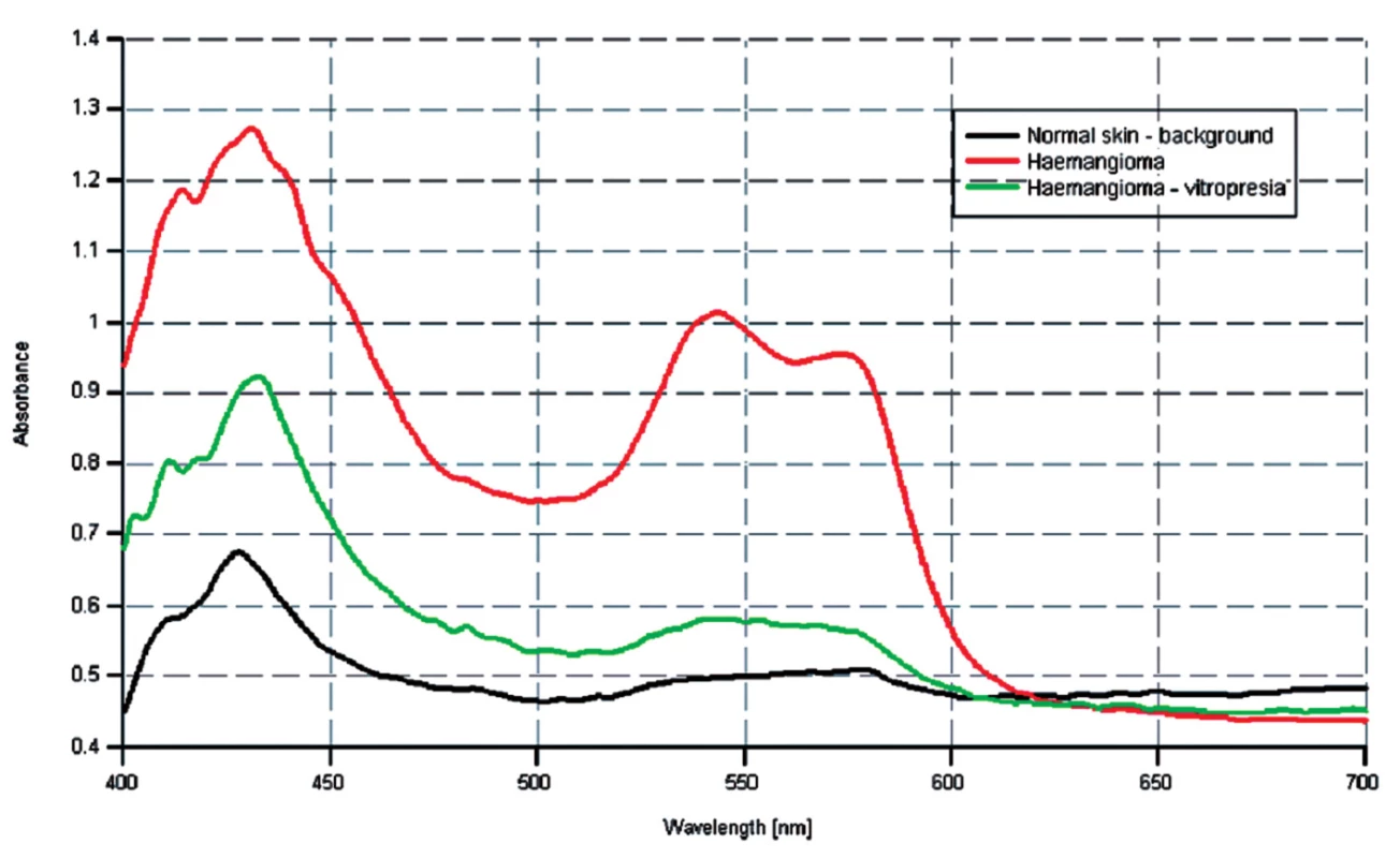 Spektrálne krivky u pacienta s hemangiómom pri vitropresii