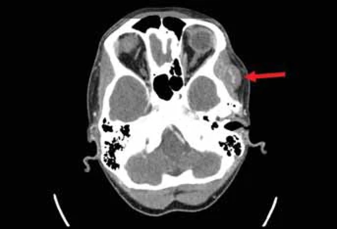 CT zobrazení (snímek v axiální rovině), šipka ukazuje na oválné ložisko s obsahem velkých cév.