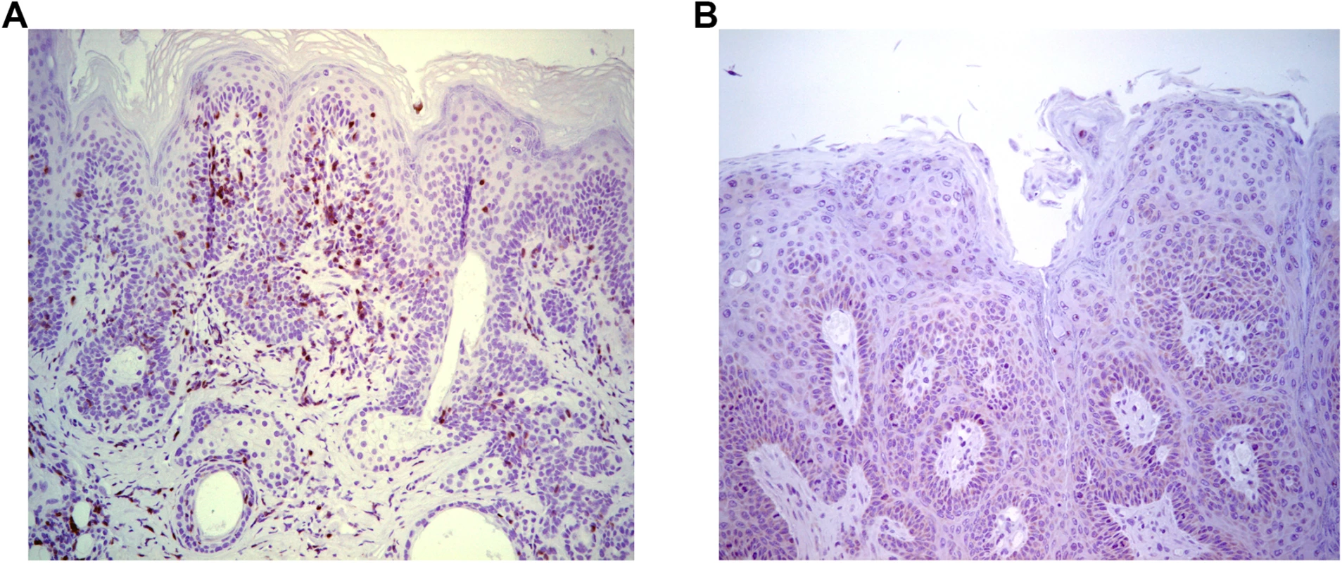 Infiltration of T cells into papilloma site associated with MusPV1 papilloma regression.