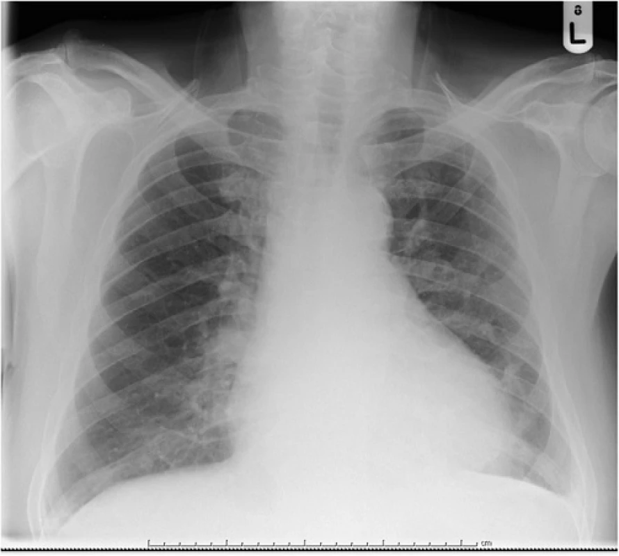 Chest radiogram showing small left-sided pleural effusion