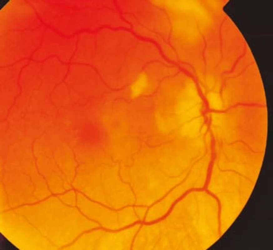 Ischemický edém terče zrakového nervu pravého oka s vatovitým ložiskem peripapilárně.