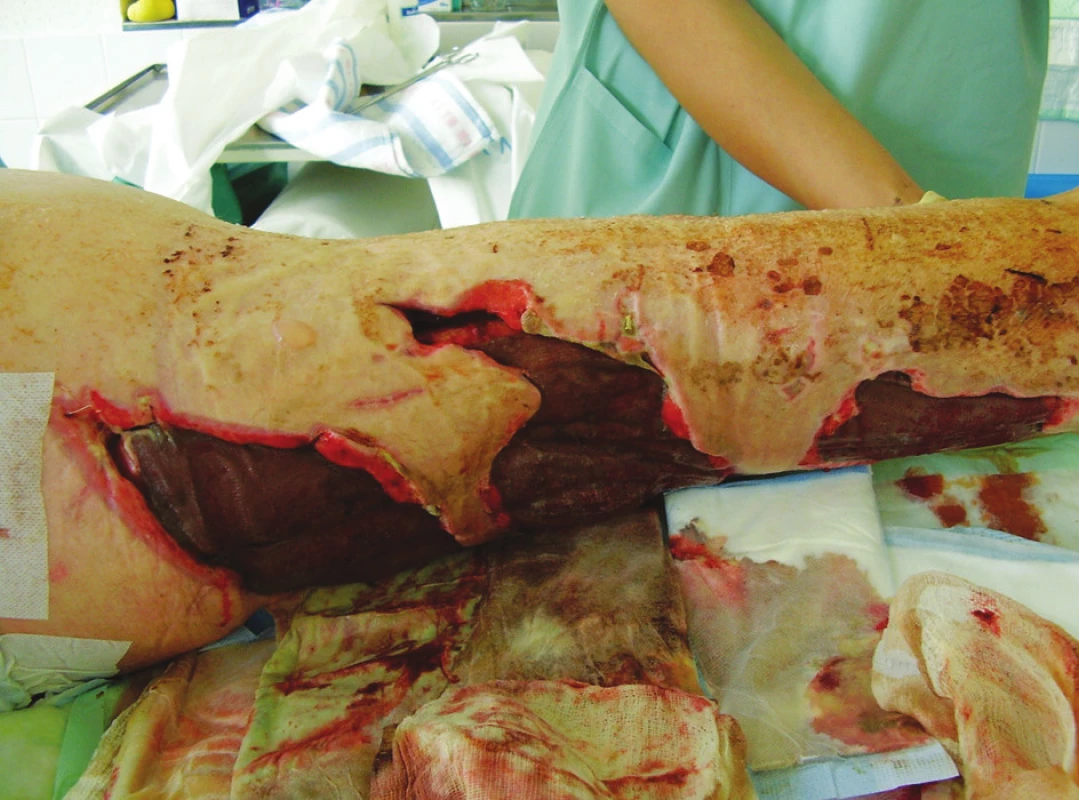 Defekty dorzální strany pravé dolní končetiny po nekrektomiích
Fig. 5. Defects of the back side of a femur after necrectomies
