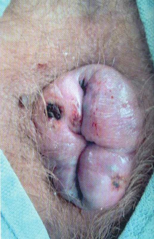 Prolabující vnitřní trombotizované hemoroidy
Fig. 2: Prolapse of internal thrombosed haemorrhoids