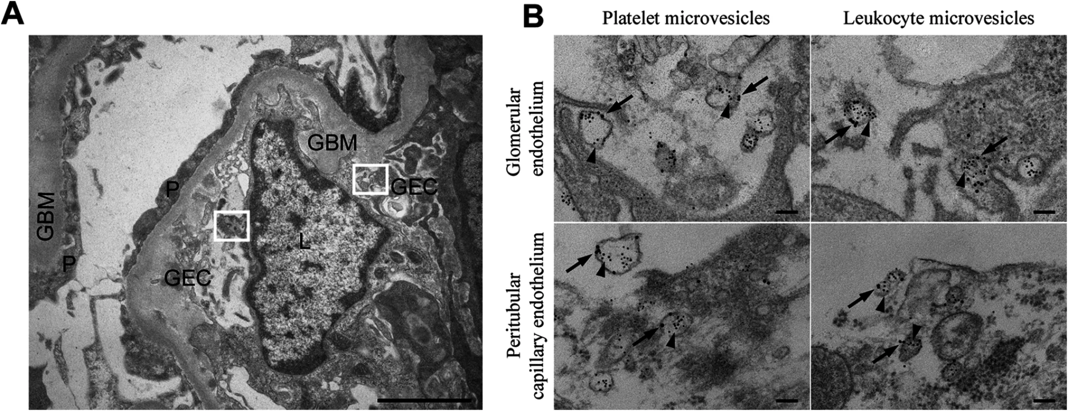 Stx2-containing blood cell-derived microvesicles detected in the renal cortex of a HUS patient.