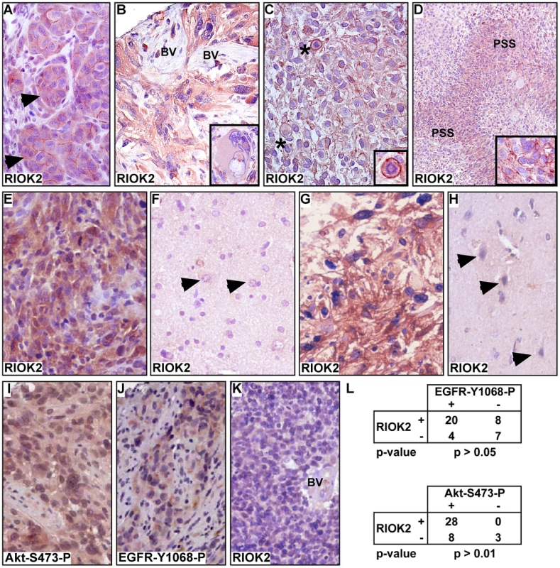 RIOK2 overexpression in GBM tumors is associated with Akt signaling.