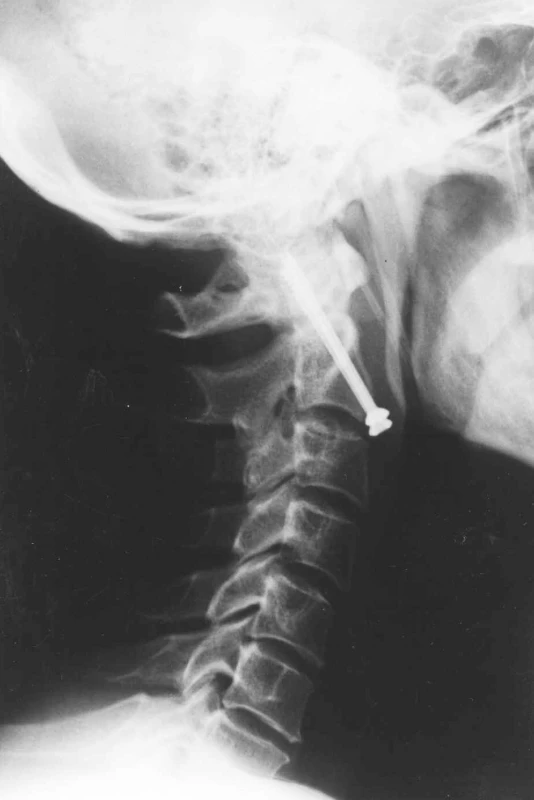 RTG obraz kompresní osteosyntézy kanalizovanými šrouby v axiální ose
Fig. 3. X-ray axial view of the compression osteosynthesis with canalised screws