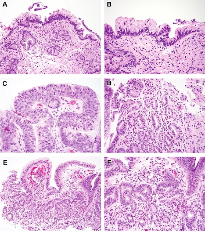 Foveolar type low-grade dysplasia. In this example the surface nuclei are hyperchromatic and each cell contains abundant neutral mucin in the manner of gastric foveolar cells. Lesions such as this are seldom encountered in our practice and most lesions with foveolar differentiation are classified as high-grade dysplasia.H&amp;E (100x). B. Higher magnification of the lesion seen in 3A, showing the nuclear detail H&amp;E (200x). C. This example of foveolar type high-grade dysplasia shows surface loss of nuclear polarity and foveolar type mucin. It was encountered at the surface of a carcinoma. H&amp;E (400x). D. Detail shows closely packed tubules with a monolayer of basal hyperchromatic nuclei with loss of polarity (loss reproducibility between adjacent nuclei and loss of relationship to the basement membrane). Some observers regard this type as “non-adenomatous” rather than foveolar since the cells have mucin characteristics of intestinalization but lack stratified nuclei. Notice that more stratified nuclei are present at the left part of the field. A small amount of foveolar mucin is seen in the cells at the lower right of the field. This type of differentiation is similar to that encountered in pyloric/cardiac differentiation but features more hyperchromatic nuclei.H&amp;E (200x). E. Foveolar type intramucosal carcinoma. Note the small round glands (high-grade dysplasia) deeper down and the surface foveolar epithelium that is focally maturing so resembles low grade foveolar dysplasia. However, the deep glands at the right are angulated with a disturbed complex architecture and beginning to invade the lamina propria. There is no desmoplastic response. H&amp;E (100x). F. Foveolar type intramucosal carcinoma. This is high magnification of the area in question in Figure 3E. The nuclei have also acquired more prominent nucleoli. H&amp;E (200x)