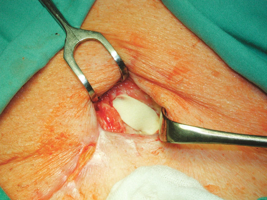 Překrytí obnažené cévní protézy vnitřní vrstvou z krytí Tielle
Fig. 4. An exposed PTFE prosthesis covered using an inner layer of the Tielle wound dressing
