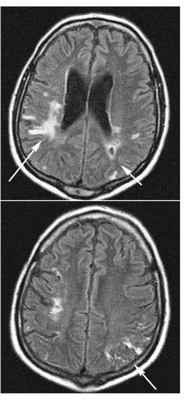 MR mozku prosinec 2006, identické řezy FLAIR sekvence
Změny vpravo prakticky stacionární (4a dlouhá šipka). 
Vlevo v oblasti dříve popisovaného edematózního prosáknutí kortikálně (4a, b) a paraventrikulárně (4a) nyní nerozsáhlé jizevnaté změny s drobnou postmalatickou pseudocystou (4a) při occipitálním rohu postranní komory (4a krátká šipka).