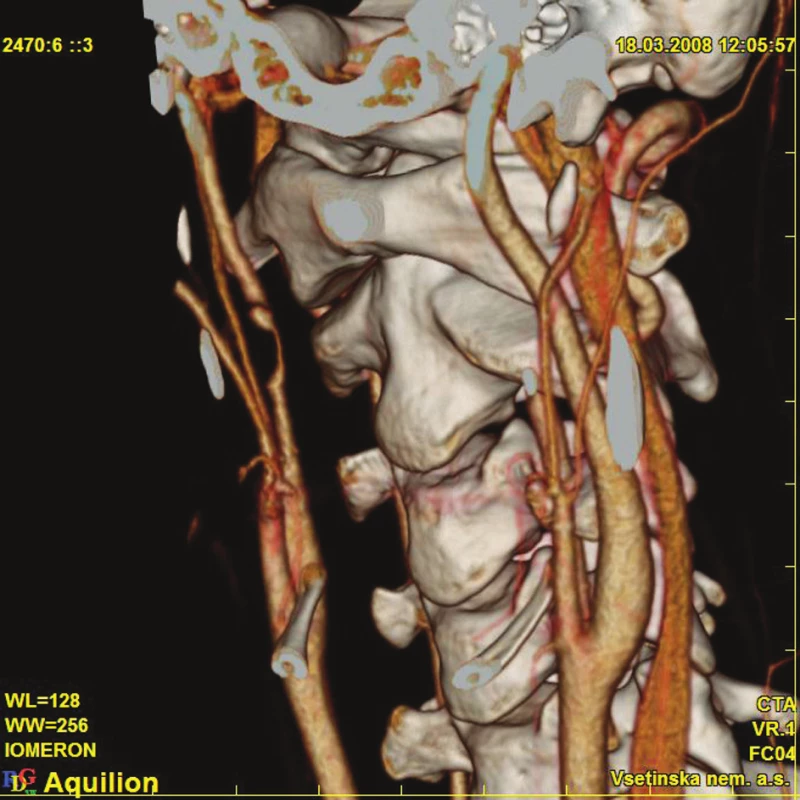 Patrné poškození a trombóza ACI vpravo 
Fig. 3. Trauma and thrombosis of the ACI is detectable on the right