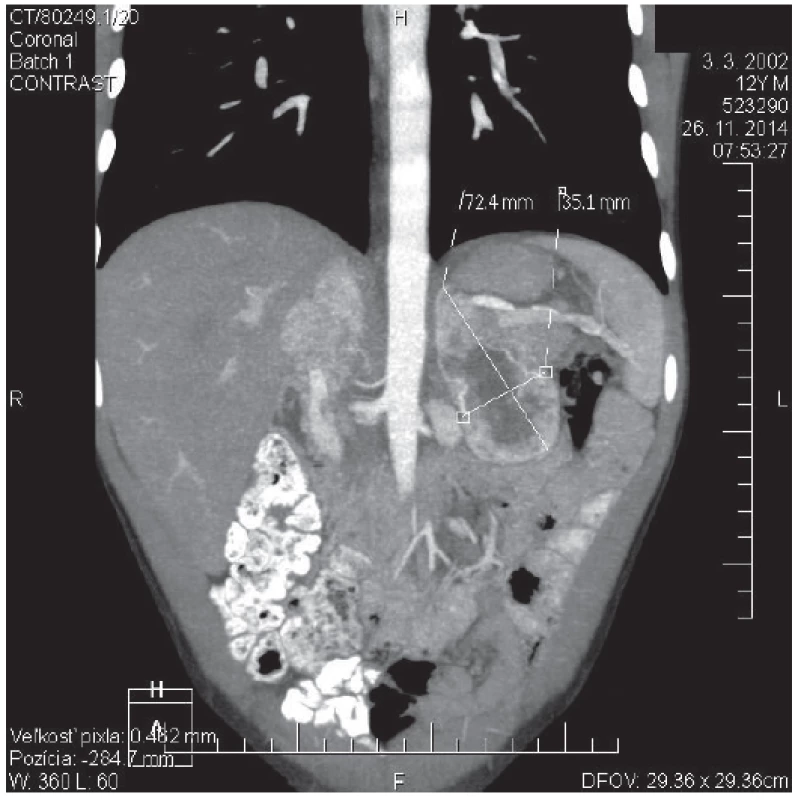 CT angio brucha s kontrastom toho istého pacienta zobrazujúce ľavú nadobličku. V oblasti ľavej nadobličky prítomný tumorózny útvar veľkosti 72 x 35 x 37 mm.
&lt;br&gt;&lt;b&gt;Fig. 2.&lt;/b&gt; Contrast CT scan of abdomen of the same patient showing left adrenal gland. In the place of left adrenal gland is present tumorous mass: 72 x 35 x 37 mm of size.