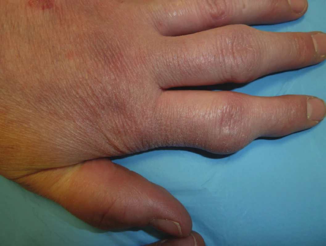 Deformity ručních kloubů