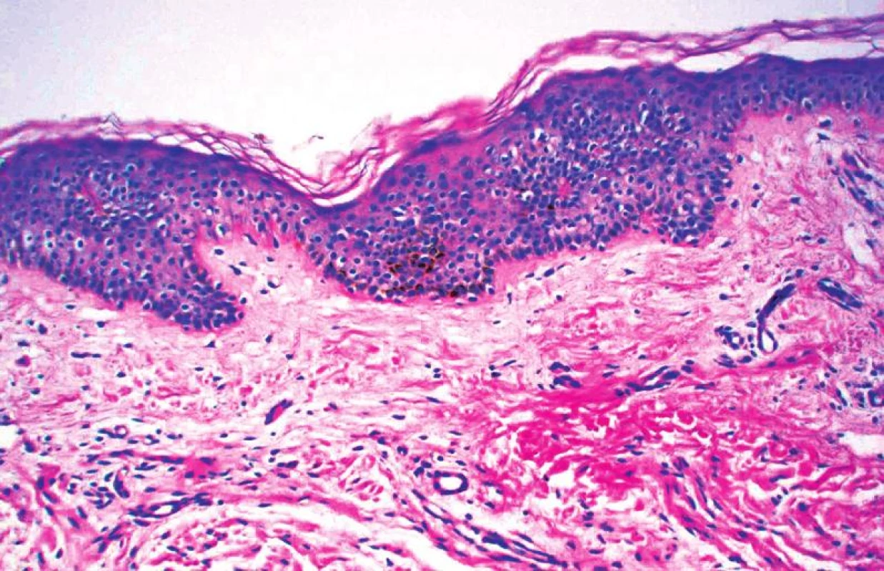 Skvrna café-au-lait – histologický obraz: pravidelná epidermis s mírnou hyperpigmentací bazální vrstvy. Ve škáře byl náhodně zjištěn neurofibrom kolem nervového svazku (HE, zvětšení 20krát).