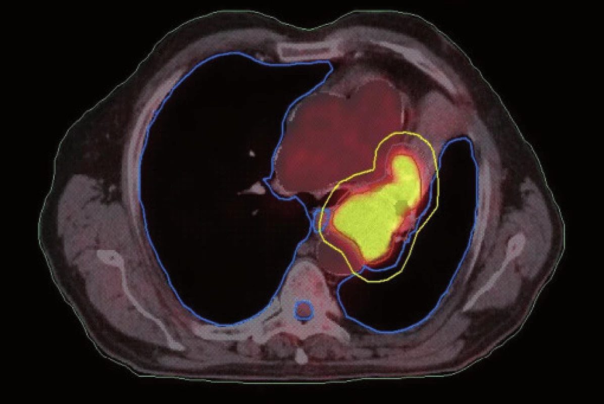 Dlaždicobuněčný karcinom způsobující atelektázu, stejný pacient jako na obr. 3. Kontrurace na základě PET/CT dat. Zde je patrné zmenšení velikosti PTV vynecháním části kolabované plíce.