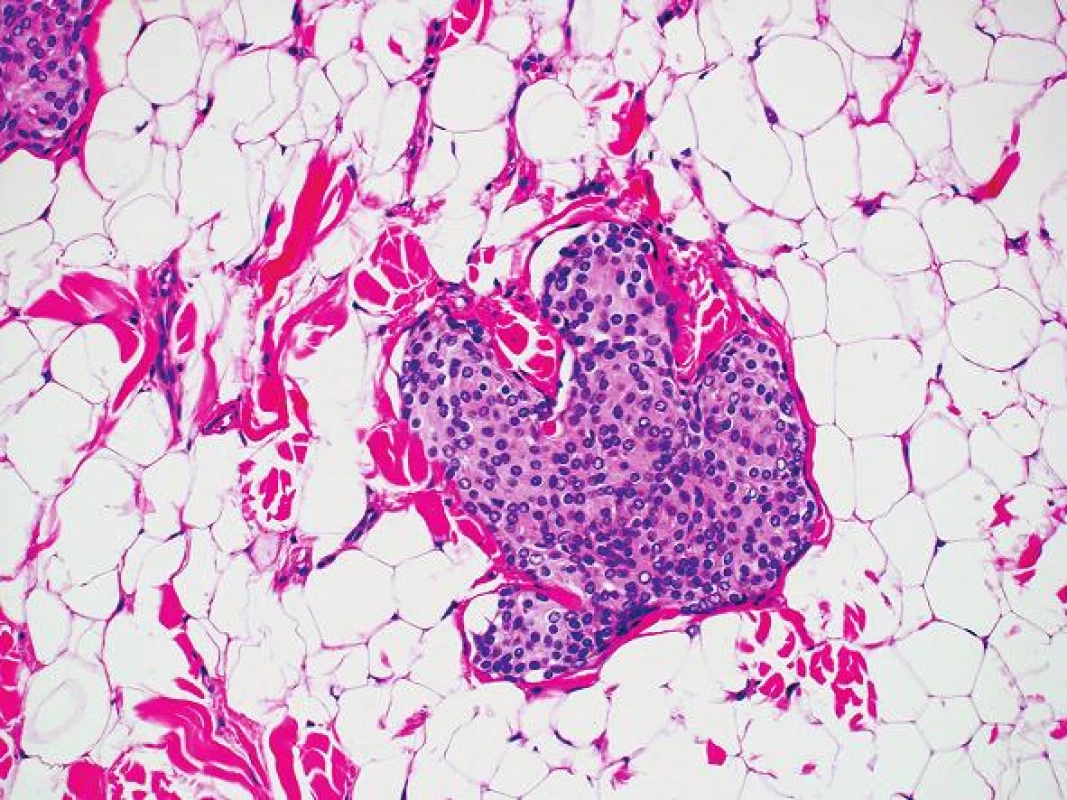 Ostrůvek meningoteliálních buněk v tukové tkáni