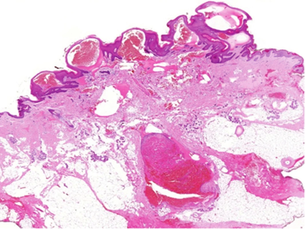 Histologický obraz verukózního hemangiomu: dilatované
tenkostěnné cévy, na povrchu hyperkeratóza