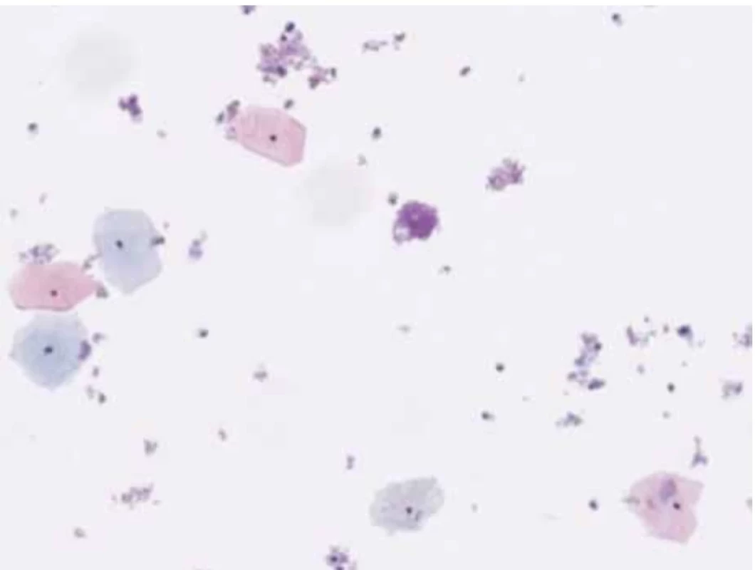 In this Pap smear, the superficial cells have pyknotic and small nuclei. Atypia is absent. (HologicThinPrep, Papanicolaou stain). // V tomto stěru měly povrchové buňky pyknotická a malá jádra. Atypie není přítomna. (ThinPrep, Hologic, barvení dle Papanicolaou).