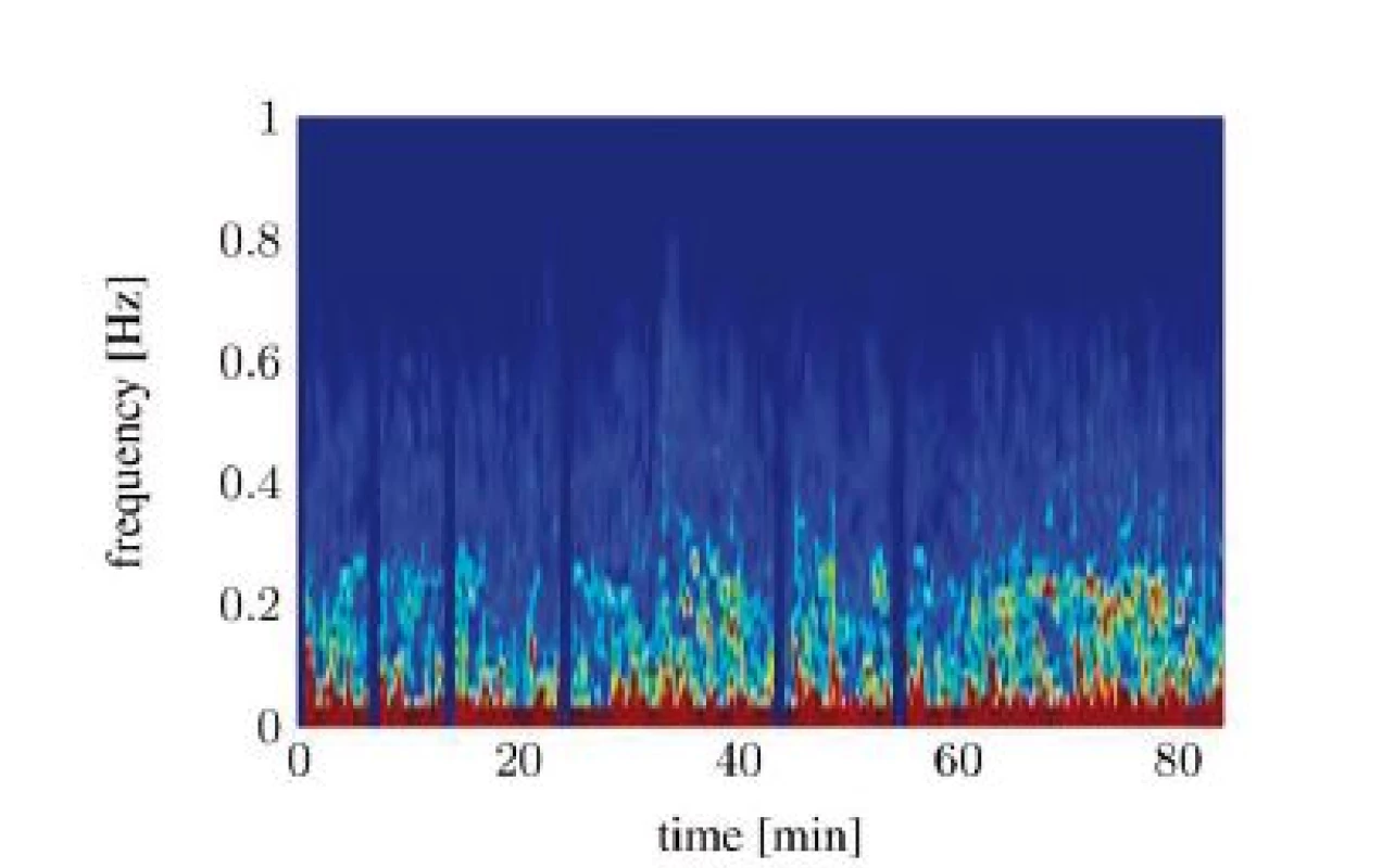 Spectral signal representation of the heart rate variability trough short time Fourier transform (pat03): noisy spectrum.
