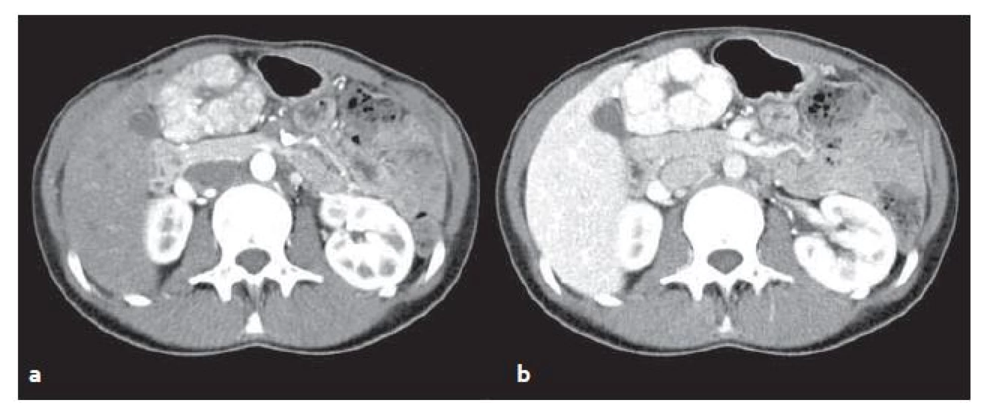 CT vyšetření u stejného pacienta jako na obr. 1 – FNH v arteriální (a) a venózní (b) fázi. V arteriální fázi se FNH oproti játrům výrazně sytí, ve venózní fázi sycení přetrvává.
Fig. 2. CT scans from the same patient as in fig. 1 – FNH in arterial (a) and venous (b) phase. In the arterial phase FNH significantly feeds contrast medium in comparison with surrounding liver parenchyma, in venous phase saturation persists.