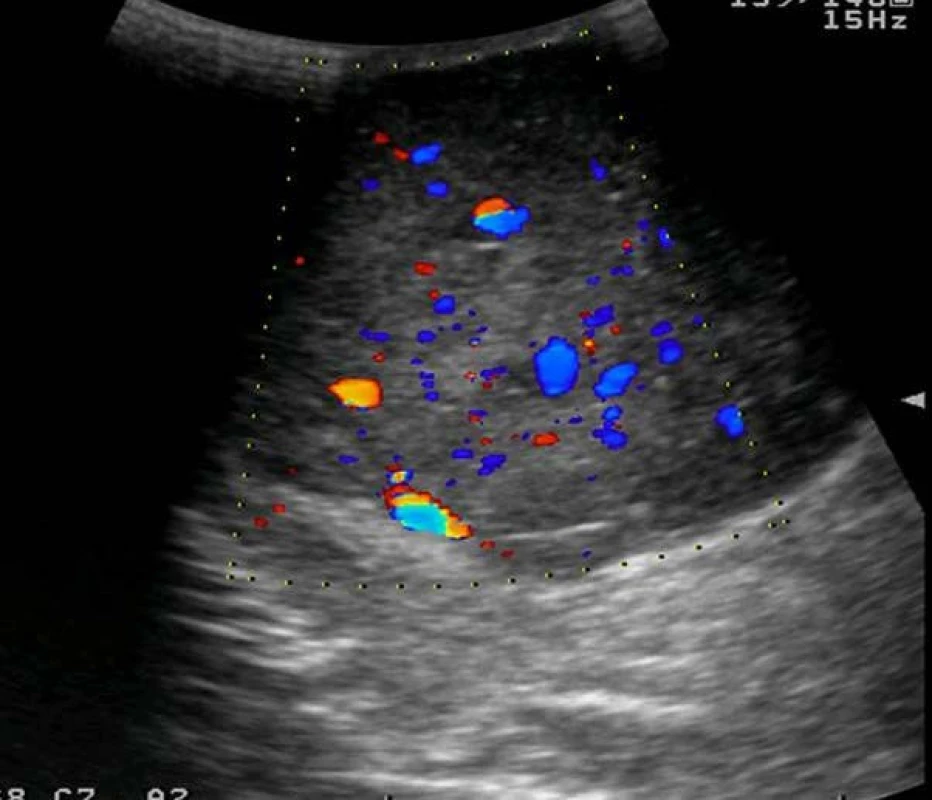 USG vyšetření varlete s patrnou hypervaskularizací tumoru
Fig. 2. Sonography of testis, hypervascularisation of tumour mass