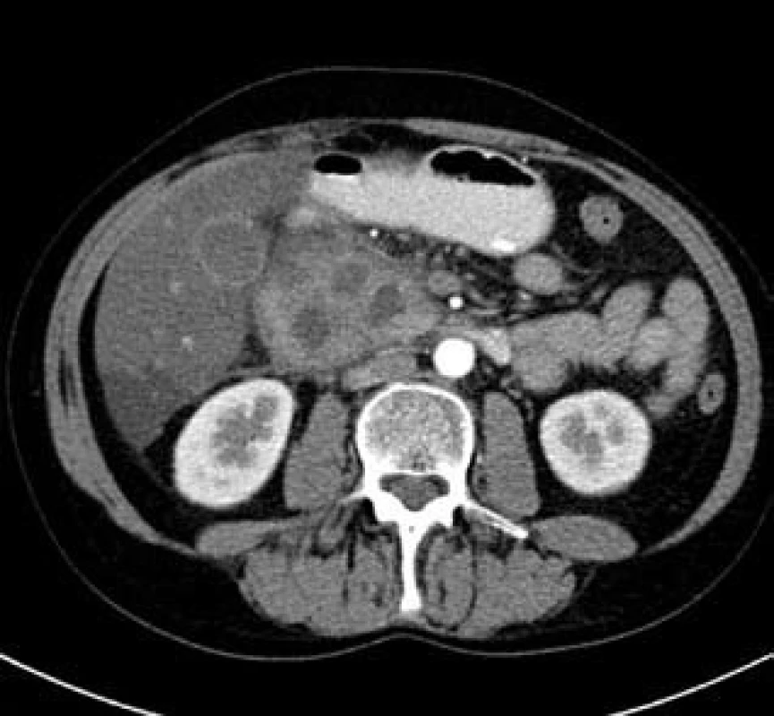 Autoimunní pankreatitida – CT nález.
Fig. 3. Autoimmune pancreatitis – CT finding.