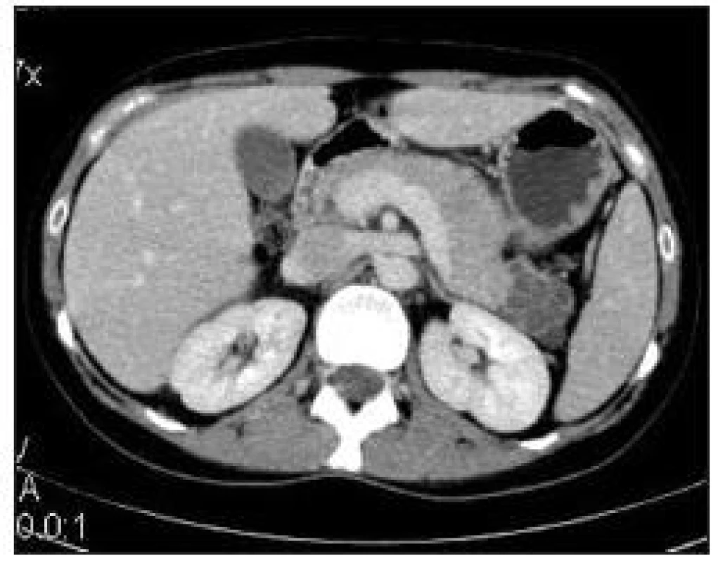 CT s kontrastní látkou i.v. ve venózní fázi, lobulovaný útvar v kaudě pankreatu, jedná se o mikrocystický serózní cystadenom.