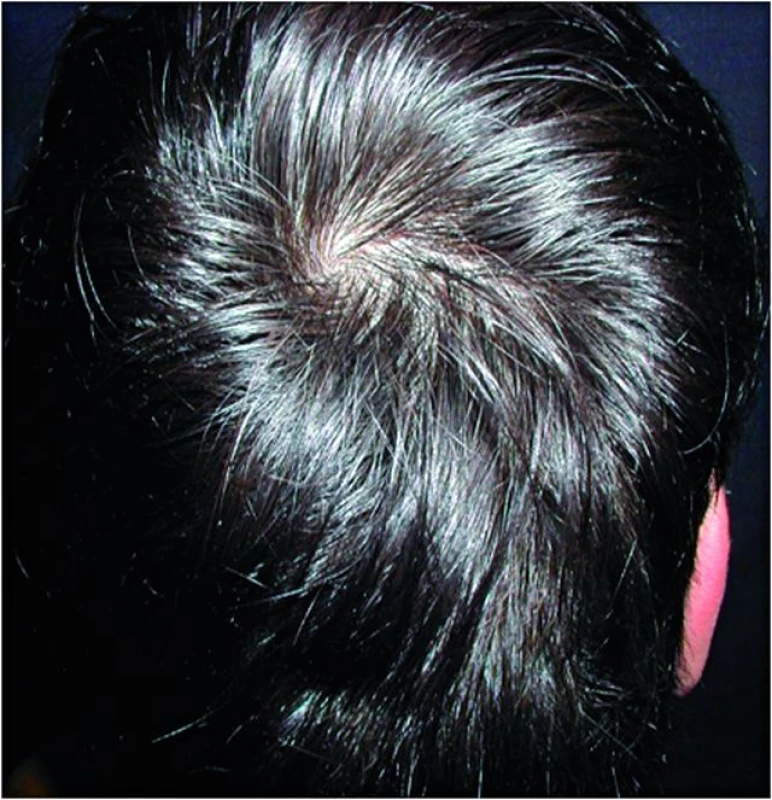 Alopecia areata po léčbě (místní léčba cignolin)