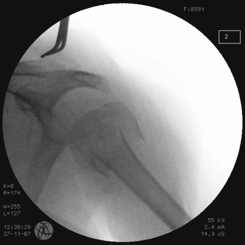 RTG obraz dislokované zlomeniny proximálního humeru u pacienta č. 1
Fig. 1. X- ray view of the dislocated proximal humeral fracture in a patient No. 1
