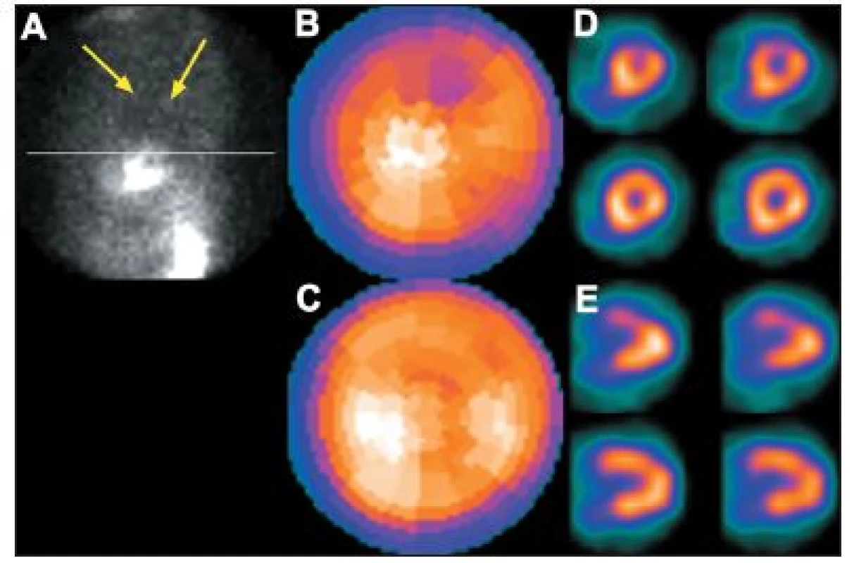 Vyšetření u pacientky s objemnými prsy. Na vybraném snímku tomografického záznamu (A) je vidět zeslabení záření levým prsem (šipky), které způsobuje arteficiální defekt perfuze na přední stěně – zobrazeno na polární mapě (B) a vybraných tomografických řezech (horní řada D – SA a E – VLA). Po stejnoměrném rozprostření tkáně prsu se perfuzní defekt již nezobrazuje – polární mapa (C)  a vybrané tomografické řezy (dolní řada D – SA a E – VLA).