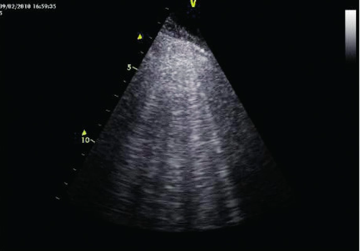 B4–B7 linie u intersticiálního plicního syndromu (pacient s ARDS)
