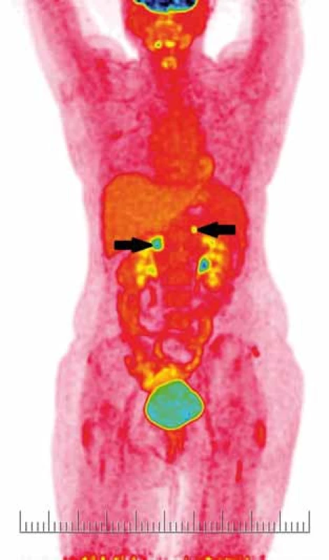 PET CT – černé šipky ukazují metastatický proces v oblasti obou nadledvin.
Fig. 5. PET CT scan – black arrows show metastases in both suprarenal glands.