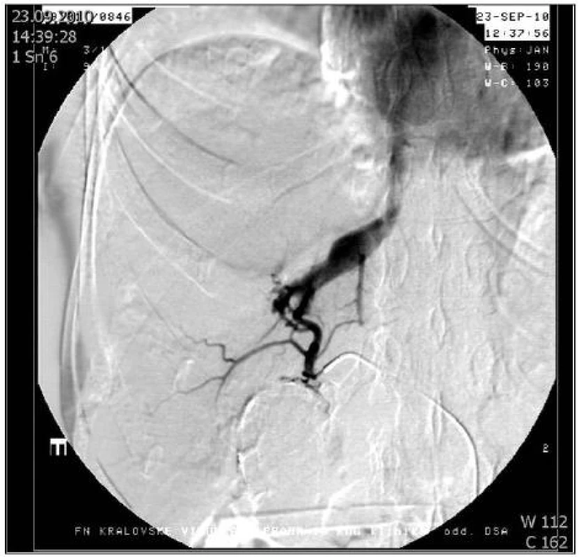 Arteriografie jaterní tepny: Arteriovenózní píštěl ošetřena embolizací