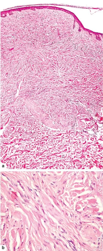 Desmoplastické névus
a – vyklenutá, minimálně pigmentovaná léze ve zhrubělém kolagenním vazivu
b – je tvořena vřetenitými nepigmentovanými melanocyty