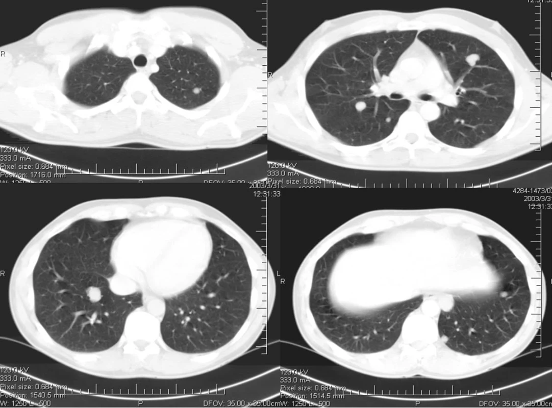 CT plic s mnohočetnými metastázami
Pic. 1. CT scan with multiple lung metastases