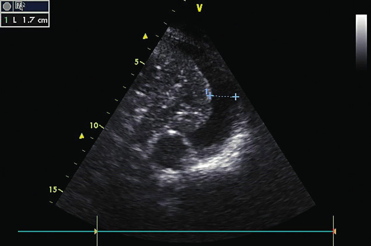 Hrudní ultrazvuk ukazující levostranný pleurální výpotek separující pleurální listy na 17 mm 
v transverzální rovině