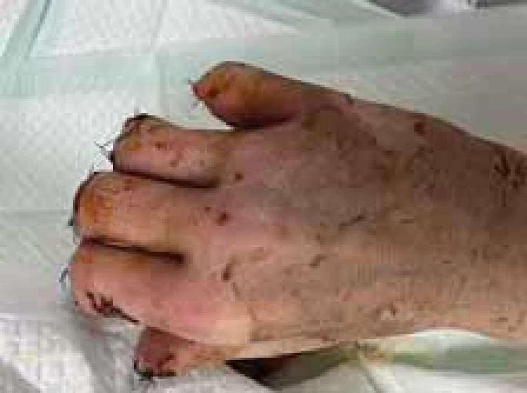 Appearance of right hand after operation (dorsal view).