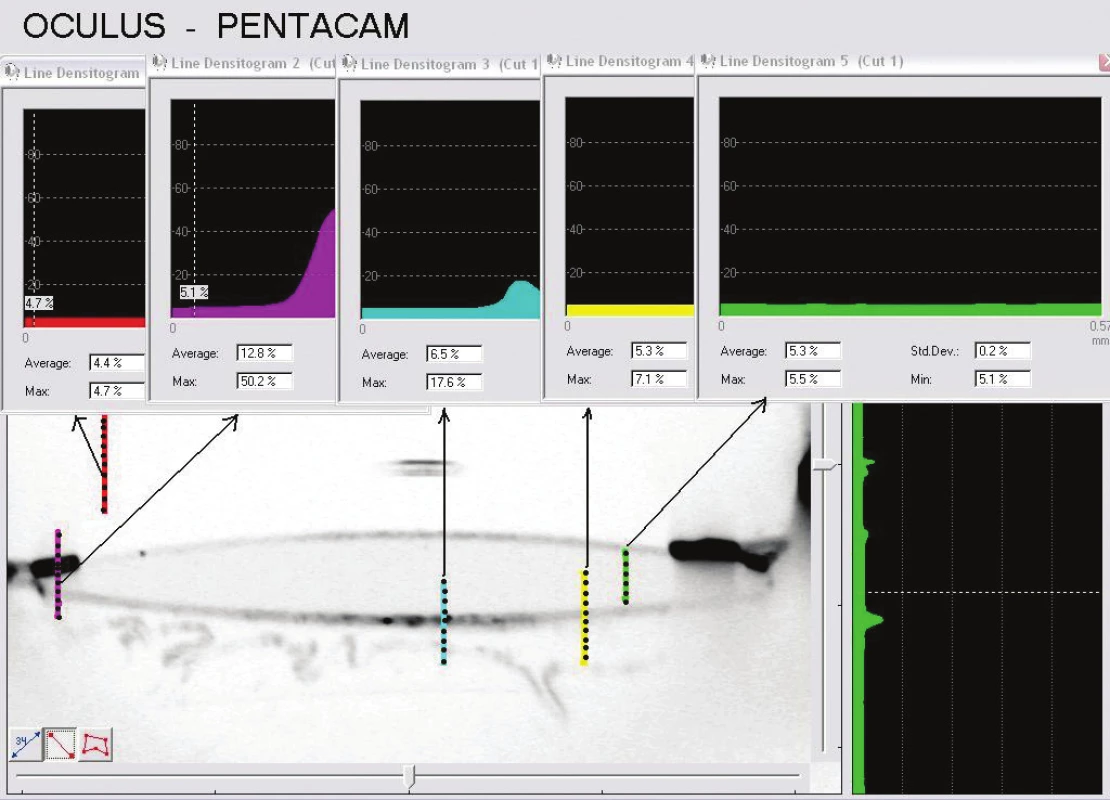 Měření denzit jednotlivých prostředí oka. Použit standardní program Pentacamu HR.